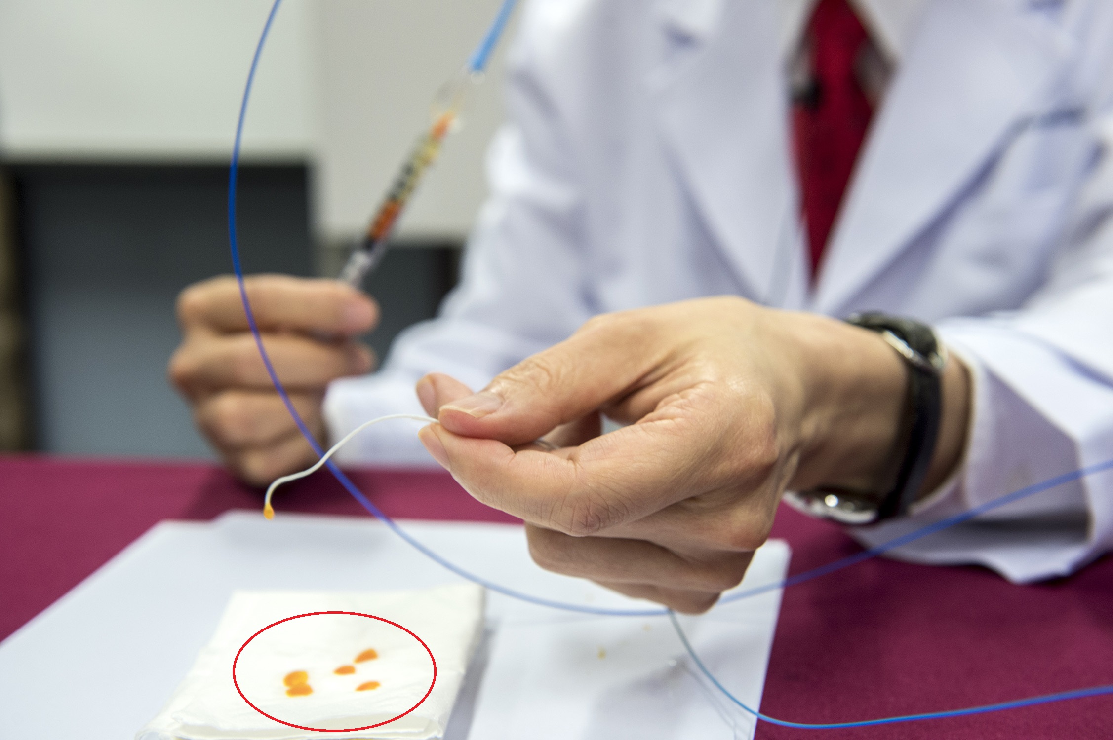  Professor YU shows the microspheres (the orange molecules circled in red) and catheter used in PAE. The microspheres are of 100 to 300 microns each in diameter, which are used to block blood flow in the microvascular of prostate.