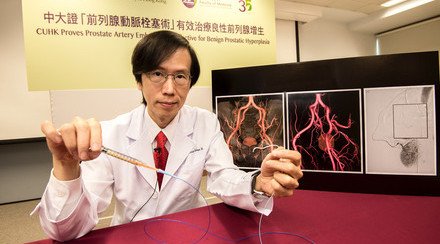 CUHK Proves Prostate Artery Embolization Effective for Benign Prostatic Hyperplasia