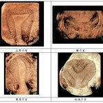 中大医学院妇科李天照教授传媒茶聚 谈惯性流产