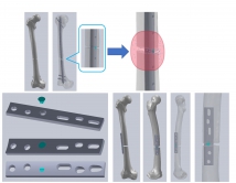 Hybrid system of Magnesium (Mg) - containing implant. The Mg plug is placed close to the fracture site and releases Mg ions which are distributed to the surrounding tissue to promote fracture healing.