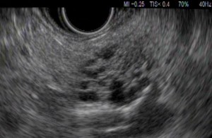 Figure-3_EUS-pancreatic-cystic-neoplasm