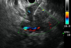 Figure-4_EUS_FNA-pancreatic-ca