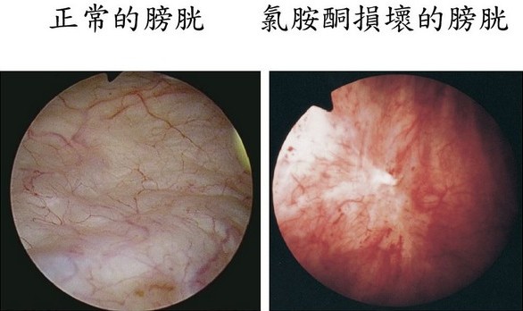 濫用氯胺酮會引致慢性膀胱發炎,甚至不可逆轉的膀胱纖維化。