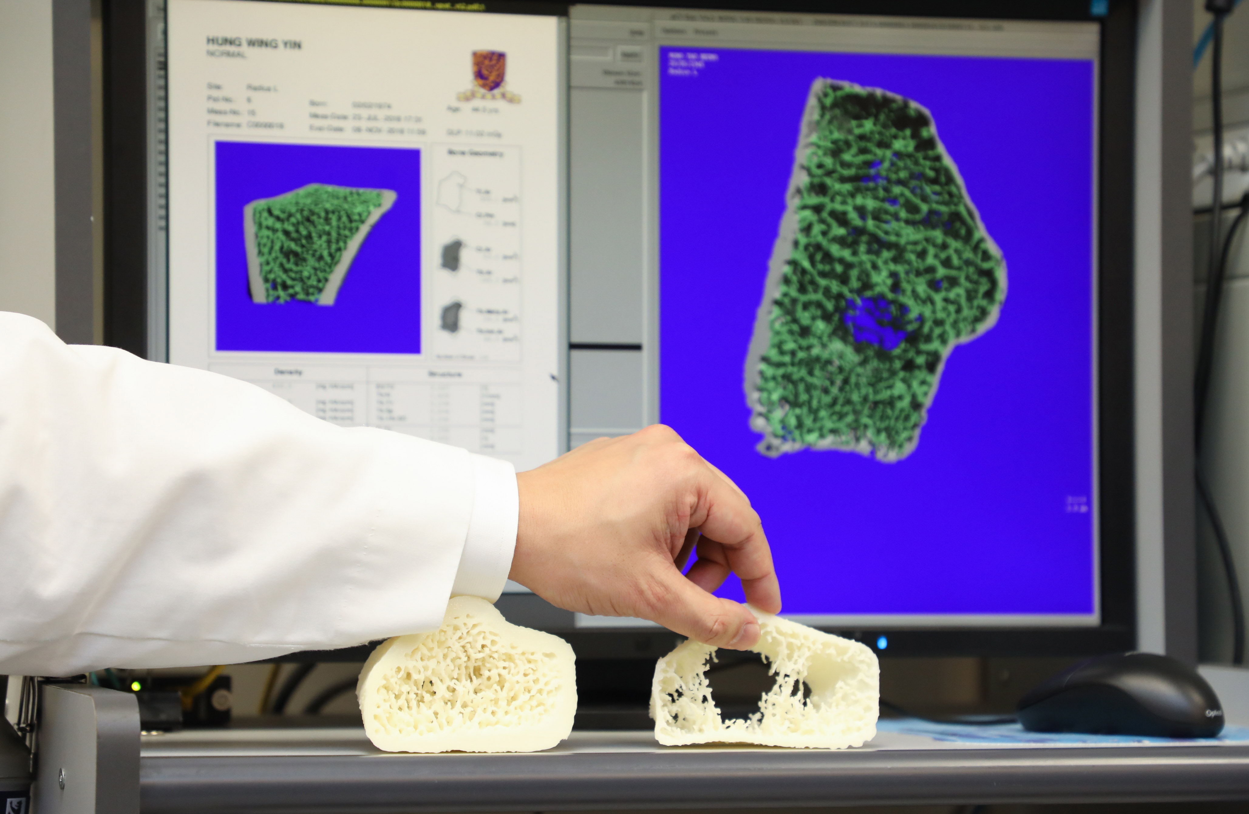 Professor Patrick YUNG explains that HR-pQCT can perform precise analysis of the bone micro-architecture, thereby developing early diagnosis of osteoporosis.