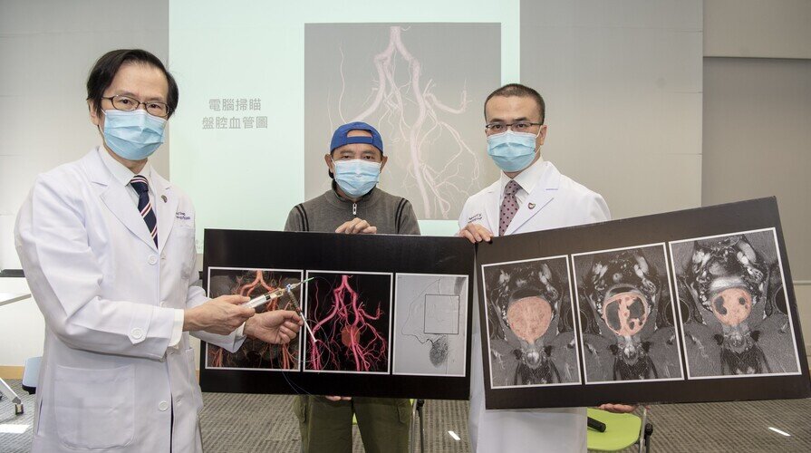 CUHK Identifies Outcome Indicators for Benign Prostatic Hyperplasia Patients Receiving Prostatic Artery Embolisation 