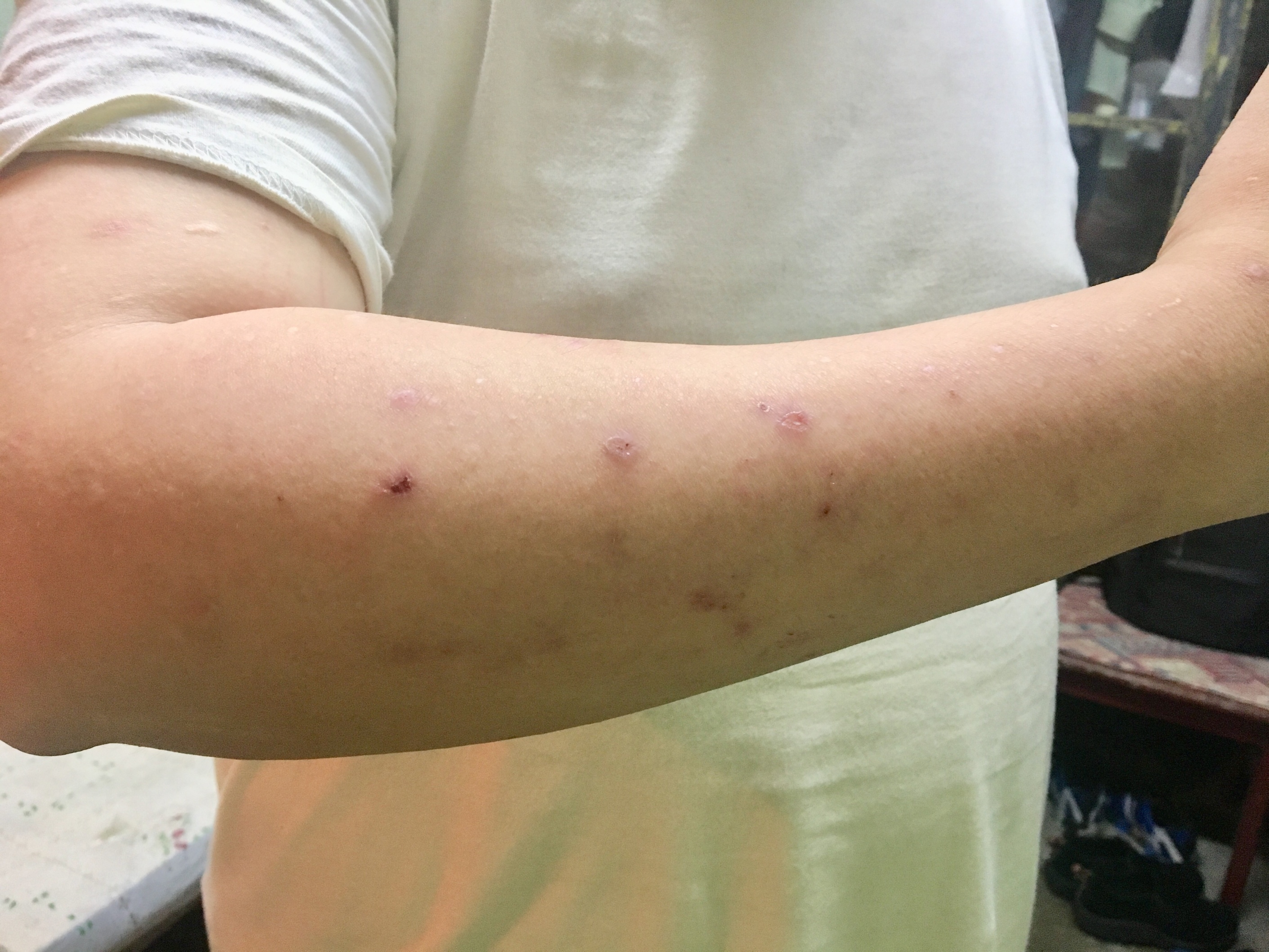 Symptoms of bite marks by bed bugs