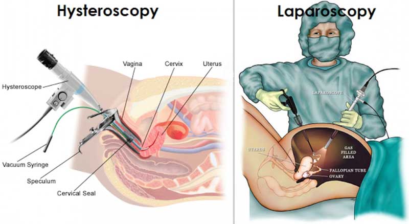 laparoscopy-and-hysteroscopy_800