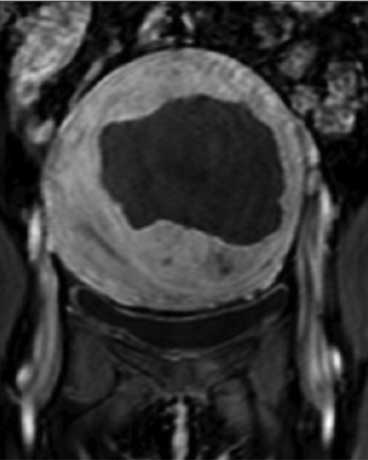 Fibroid after treatment