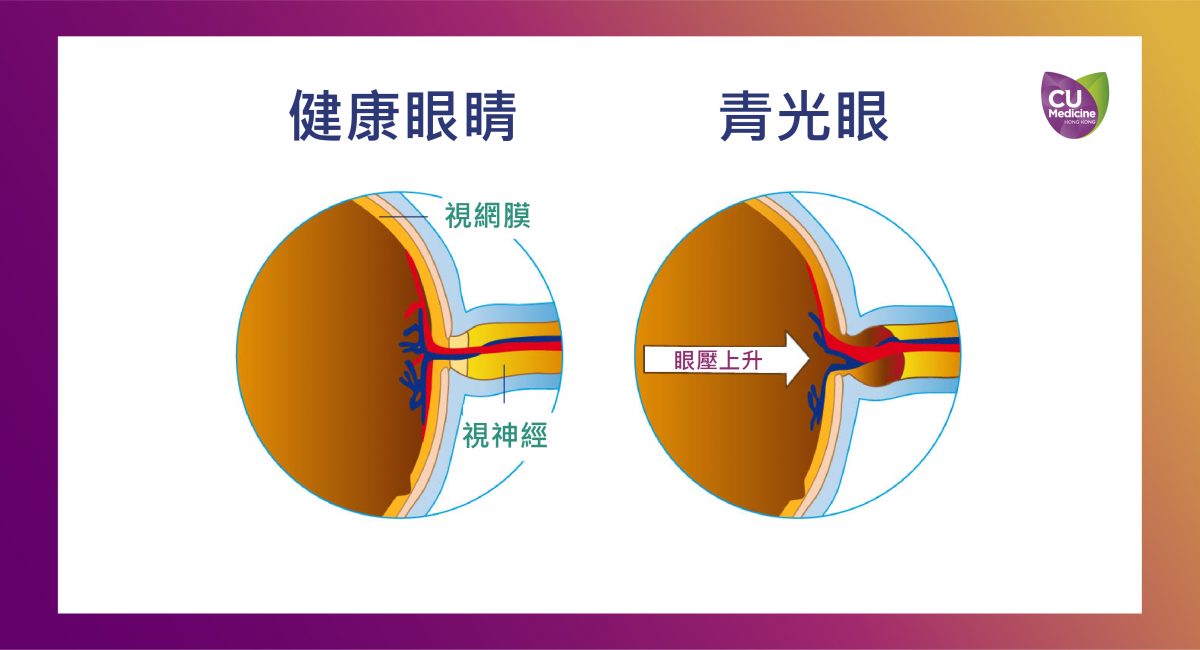 青光眼