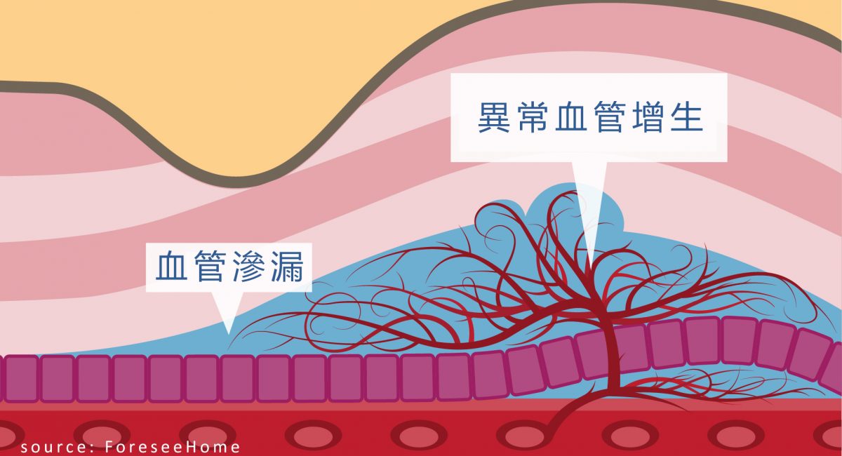 致盲眼疾息肉狀脈絡膜血管病變