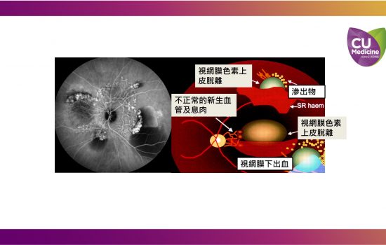 港約有50萬人患有黃斑病變，當中最棘手是「息肉狀脈絡膜血管病變」