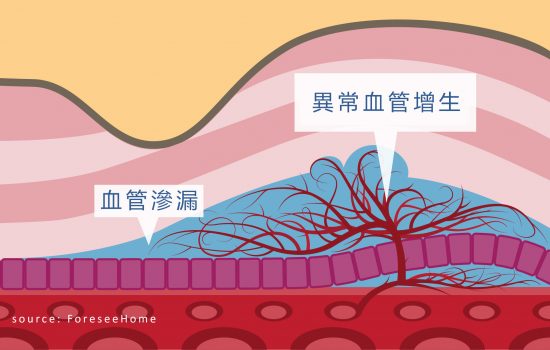 致盲眼疾息肉狀脈絡膜血管病變