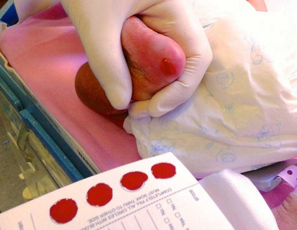 The screening test for IEM requires only a few drops of blood collected by pricking the baby’s heel and the results will be available within a few days.