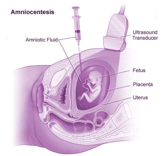 Amniocentesis