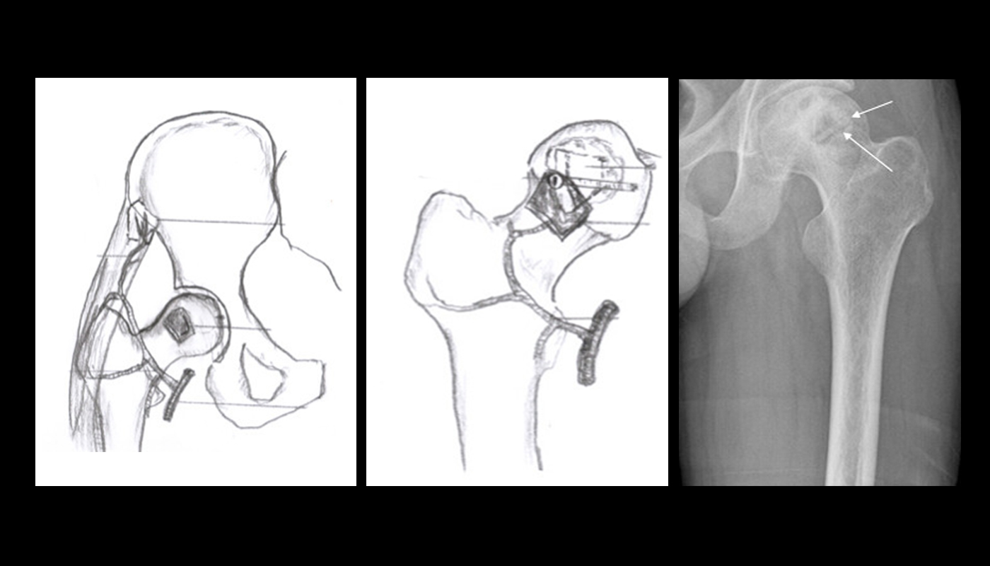 Professor Qin’s team develops a magnesium screw that dissolves entirely, aiding in the bone formation around the join site in the process (Source: Zhao DW, et al. <em>Biomaterials</em> 2016)