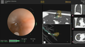 The real-time optical imaging and electromagnetic positioning enables doctors to preview the location of the lesion. If it appears green colour, meaning it’s in the safe zone to deploy the biopsy tool.