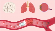 A conceptual illustration of microrobotic swarm for active delivery and localised therapy in vivo. (Credit: Xingzhou Du from Professor Li Zhang’s laboratory)