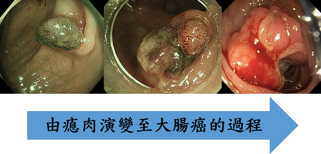 瘜肉變大腸癌