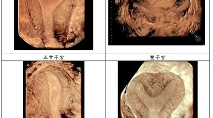 中大醫學院婦科李天照教授傳媒茶聚 談慣性流產