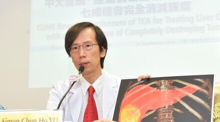 中大发现「经血管乙醇消融术 」治肝癌 七成机会完全消灭肿瘤