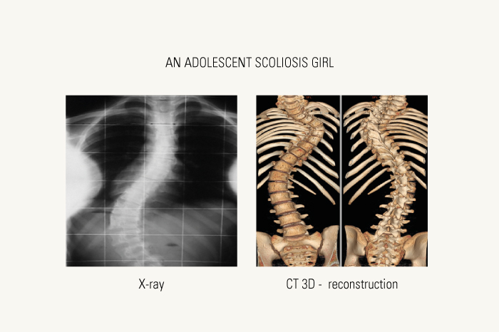 X-ray and CT images of scoliosis