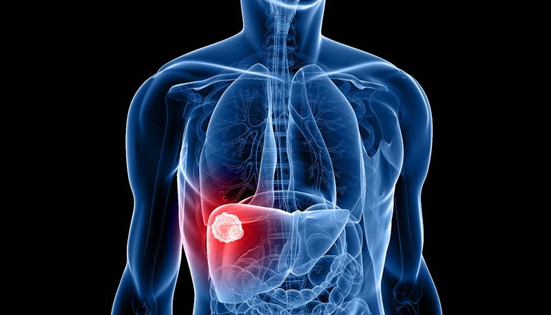 The School of Biomedical Sciences develops a new treatment for liver cancer using a cancer-promoting gene and immune checkpoint inhibitors.