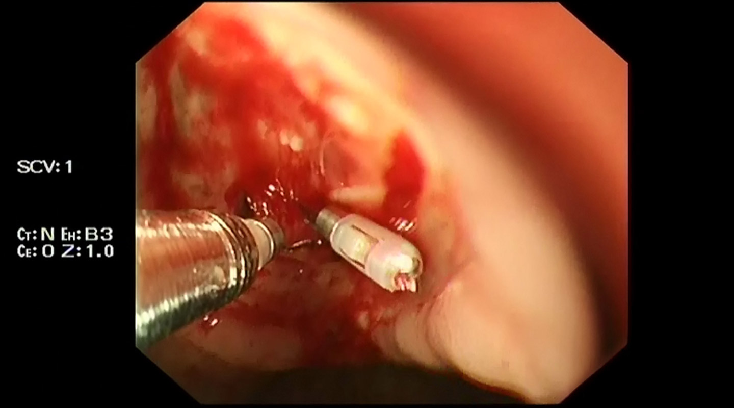 Endoscopic hemostasis, an endoscopic therapy involving surgery through endoscope with various techniques and tools, is an effective means to control bleeding in ulcers